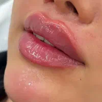 جشنواره تابستانه بوتاکس و تزریق فیلر
