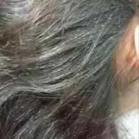 درمان شپش و رشک