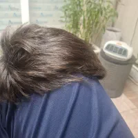 پروتز مو
