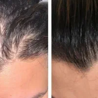 پرونده PRP رو برای همیشه ببند
