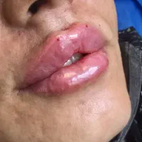 بوتاکس،ژل،مزوتراپی و خدمات زیبایی