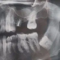 جراحی تخصصی دندان عقل و لثه با(تعرفه دولتی )
