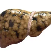 کبد چرب گرید یک ،دو