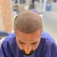 کاشت تخصصی مو