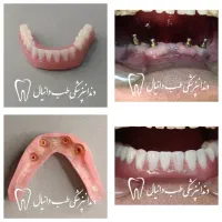 دندان مصنوعی،روکش،ایمپلنت دندانپزشکی دکتر نقوی