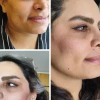 نیازمند مدل ژل و بوتاکس تمامی نواحی صورت