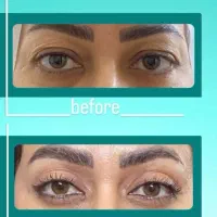 لیپوساکشن و ابدومینوپلاستی و بلفاروپلاستی