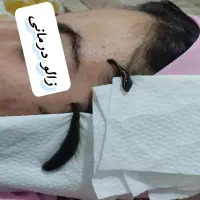 حجامت، فصد خون، زالو درمانی در منزل