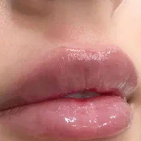 فرصت طلایی تزریق فیلر و بوتاکس رایگان توسط پزشک