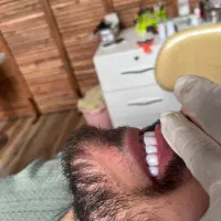 کامپوزیت دندان و عصبکشی دندان و بیلیچینگ وجرمگیری