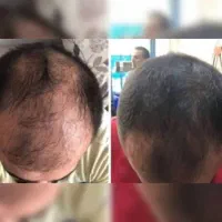 از شر طاسی خلاص شو