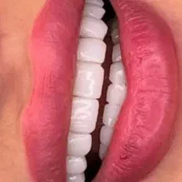 آموزش تخصصی کامپوزیت لمینت وروکش بلیچینگ
