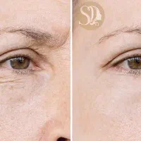 معجزه اندولیفت (ده سال جوان تر شوید فقط دریک جلسه)