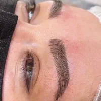 مرکز ریموو ، میکروبلیدینگ موخوره گیری