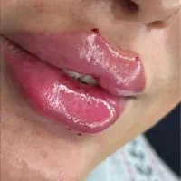 تخفیف ویژه ی فیلر وبوتاکس ومزوتراپی