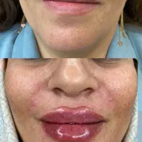 ژل بوتاکس لیزر فقط 380تومان