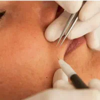 حذف موهای زاید سفید، خال و زگیل و کک ومک