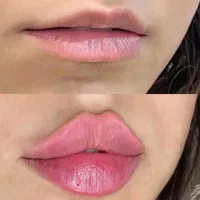 تزریق ژل وفیلر،بوتاکس ،جوانساز ،مزوژل، چربی سوز