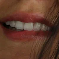 دندانپزشکی کامپوزیت، دندان مصنوعی، فیلیپر، عصب کشی