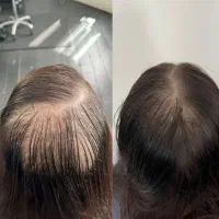 راهکار قطعی برای رشد مو