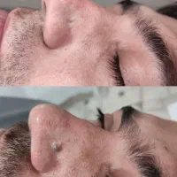 آموزش خال برداری زگیل میکرونیدلینگ/بوتاکس تزریقات