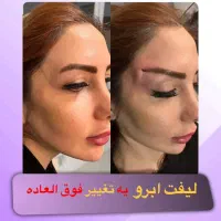 لیفت شقیقه صورت بلفاروپلاسی جراحی پلک پی آر پی