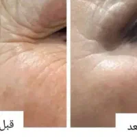 جوانسازی و لیفت بدون تزریق