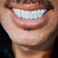 (خیریه)ساخت پروتز متحرک(دندان مصنوعی)