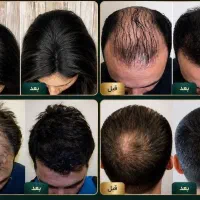 رفع طاسی سر و کم پشتی مو