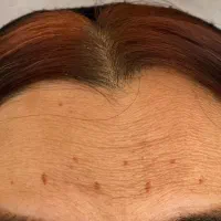 اموزش ژل وبوتاکس ازصفرتاصد