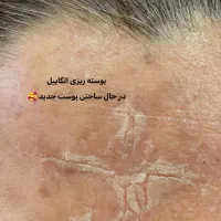 درمان قطعی کک ‌و‌ مک و لک (فیشیال اقتصادی و‌ ویژه)