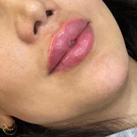 ژل لب،ژل باسن،بوتاکس هایفو نخ،مزو،زاویه سازی صورت