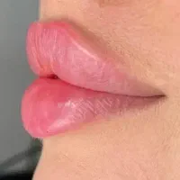 بایو فیلر.مزو.پی آر پی.ژل .بوتاکس