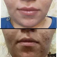 لک ها تو راحت از بین ببر