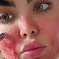مزوتراپی میکرونیدلینگ جوانساز