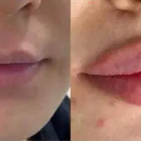 افر بهاره ژل،فیلر،لاغری بوتاکس،کانتورینگ و لب