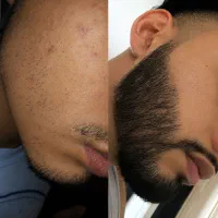 ریش نداری کنسلی