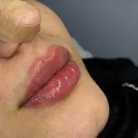 تزریق ژل و بوتاکس