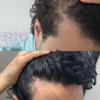 درمان ریزش مو و کم پشتی