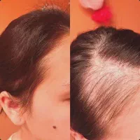 قبل از کاشت مو این را بدانید