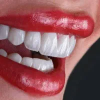 خدمات ایمپلنت بصورت اقساط با ضمانت ۱۰ ساله