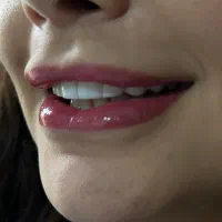 کامپوزیت و کاشت دندان با بهترین متریال و قیمت|خدمات آرایشگری و زیبایی|ساری, |دیوار