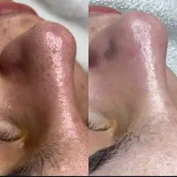 فیشیال تخصصی (پاکسازی پوست)