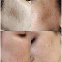 اسکراب اسکالپ و فیشال و پاکسازی پوست