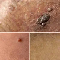 مشاوره و بهبودی اچ پی وی و زگیل