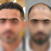کاشت مو با ۳ میلیون در تبریز
