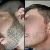پکیج رویش ریش