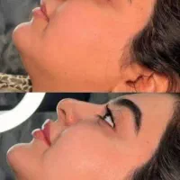 فیلر بوتاکس