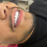 ونیر کامپوزیت دندان روکش سرامیکی دندان لمینت