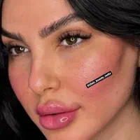 تزریق ژل و فیلر لب،گونه،مادلینگ،زاویه فک،چانه روسی